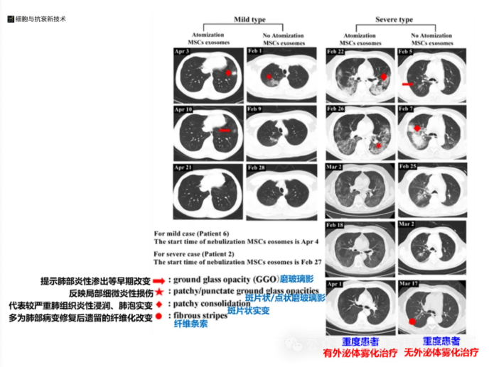外泌體霧化對肺部炎癥損傷有良好治療作用